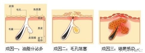 痘痘的生长过程视频,痘痘的发展过程素材