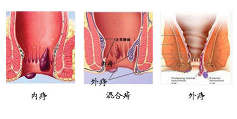 痔疮疼痛难忍出血怎么办,得了痔疮疼痛该怎么办