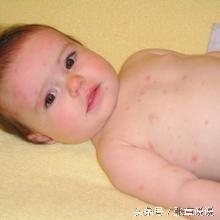 小孩子长水痘怎么治疗,小孩水痘留下的痘怎么办