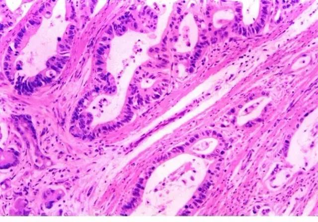 糖尿病肾病病理类型,肾病的类型有哪些