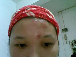 去掉额头上的痘痘用什么药膏,如何让额头上的痘痘消失