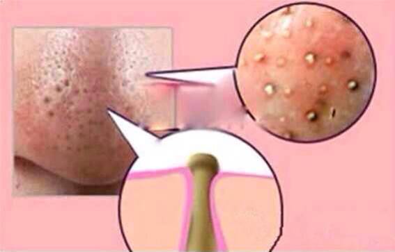 第一次刷酸去黑头新手教程,黑头处理工具用法