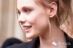 点痣会引发痣癌变吗,痣旁边长了小痣是不是癌变