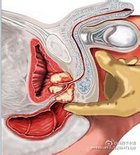 悲喜交加的前列腺癌：前列腺癌的诊断及治疗！