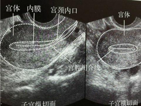 经期第13天内膜6mm，较大卵泡15*14是否正常？