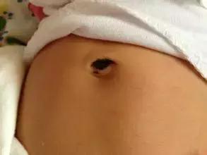 肚脐眼下面腹痛有卵巢囊肿,肚脐右侧有一个囊肿是怎么回事