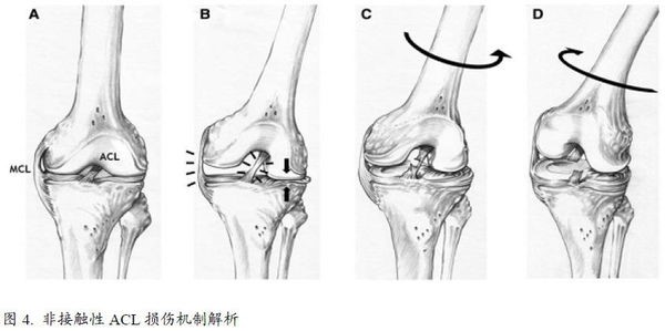 膝盖前交叉韧带损伤一般多久恢复,谈前交叉韧带