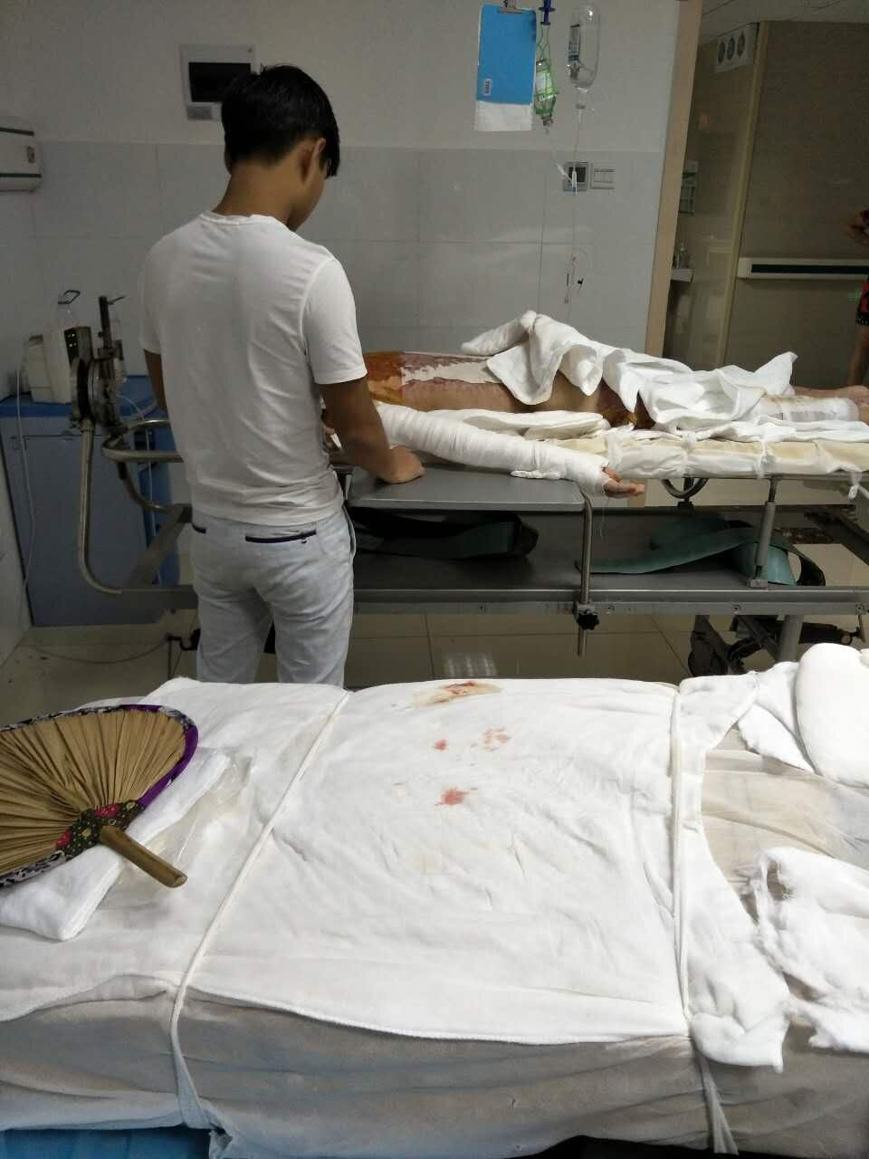 父亲大面积烧伤放弃治疗,一位6岁男孩父亲重度烧伤