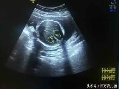 胎儿左侧脉络丛囊肿26周复查增大,胎儿脉络丛囊肿隔多久检查一次