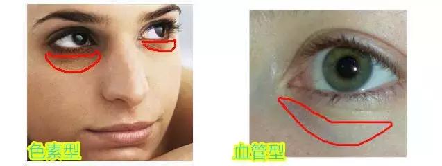 黑眼圈很重又必须熬夜怎么办,熬夜上夜班黑眼圈加重怎么消除