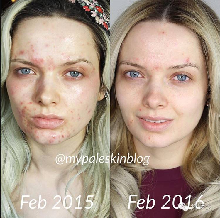 祛痘还是不要和三纲五常斗了，法国顶级皮肤科大夫有话说