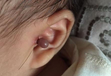 宝宝长了附耳有必要切除吗,宝宝长附耳是男方还是女方的原因