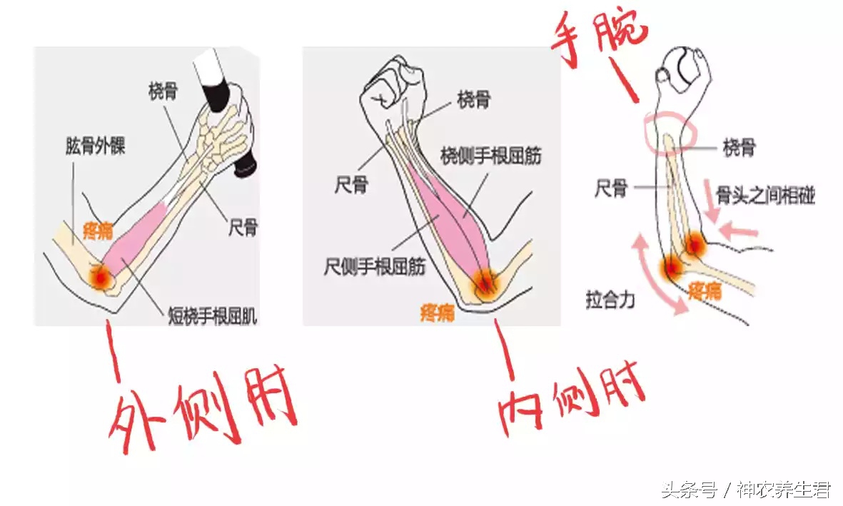 十大常见运动损伤部位及防治,运动损伤最容易出现部位