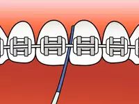 戴上牙套怎么刷牙视频,牙套矫正刷牙的重要性