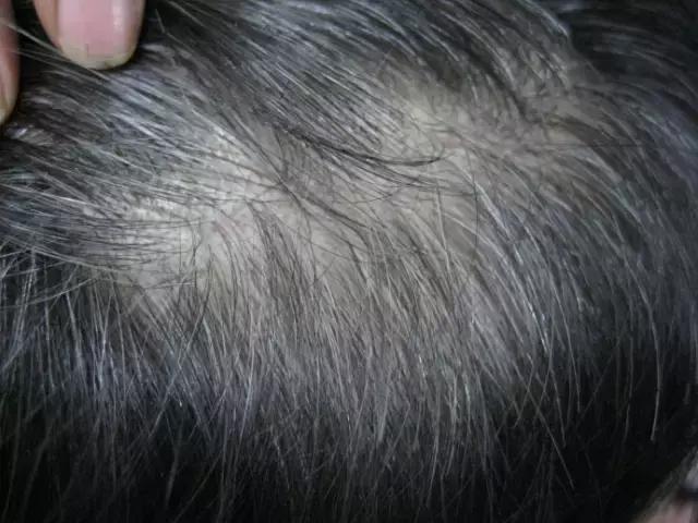 少白头变黑教程,14岁少白头吃什么能变黑