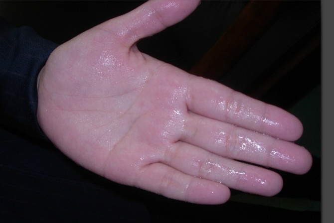 手汗多，脚汗多，1个外洗古方屡屡有效
