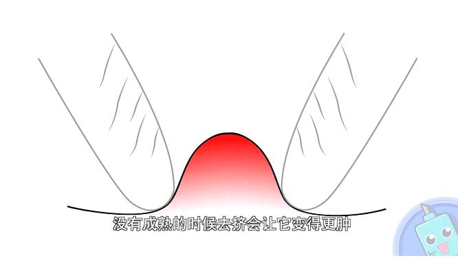 挤痘怎样才能不留痘坑,挤痘痘不留痘印的小妙招