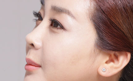 鼻子不好看能改善吗,大鼻子不好看怎么办