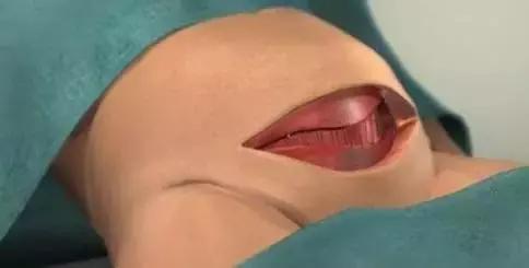 横切剖宫产后的疤痕,剖腹产横切和竖切二年愈合照片