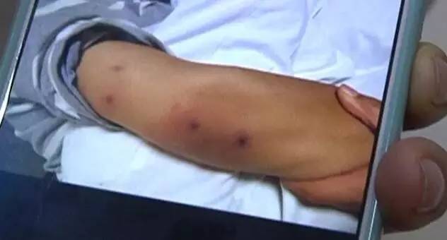 7岁小孩被虫蛰,浙江小朋友被虫子蛰