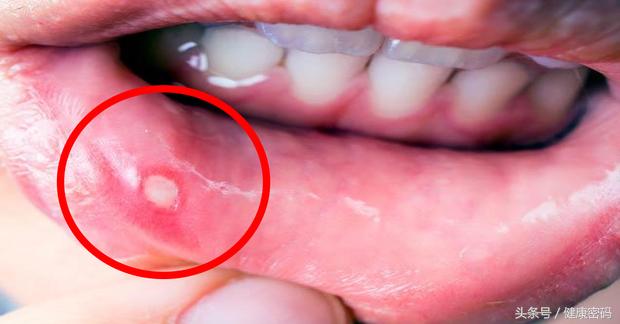 口腔溃疡口水流出来导致嘴边溃烂,牙龈内侧口腔溃疡