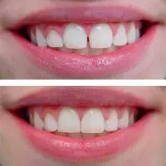 牙中间有缝怎么办,前牙有缝修复