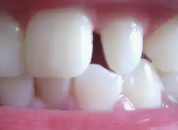 牙中间有缝怎么办,前牙有缝修复