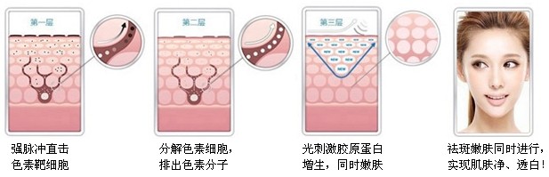 黑色素提取祛斑和激光祛斑哪个好,彩光祛斑和激光祛斑的区别是什么