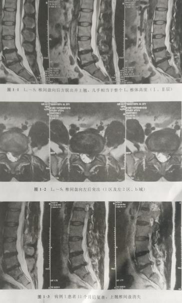 腰椎间盘突出可以练瑜伽吗,腰椎间盘突出可以做什么运动