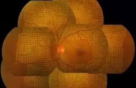 眼前一直有蚊子是什么病,眼前总有蚊子飞怎么治呀