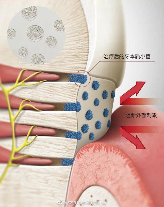 牙科医生推荐的美白牙齿的产品,牙科医生推荐牙膏修复牙釉质