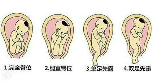 脐带绕颈胎位不正怎么办,胎位不正医生调胎位痛苦