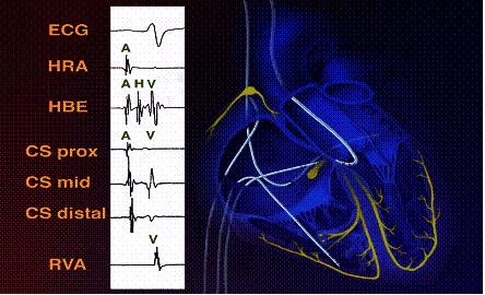 预激综合征射频消融术的护理,室上速射频消融术后如何护理