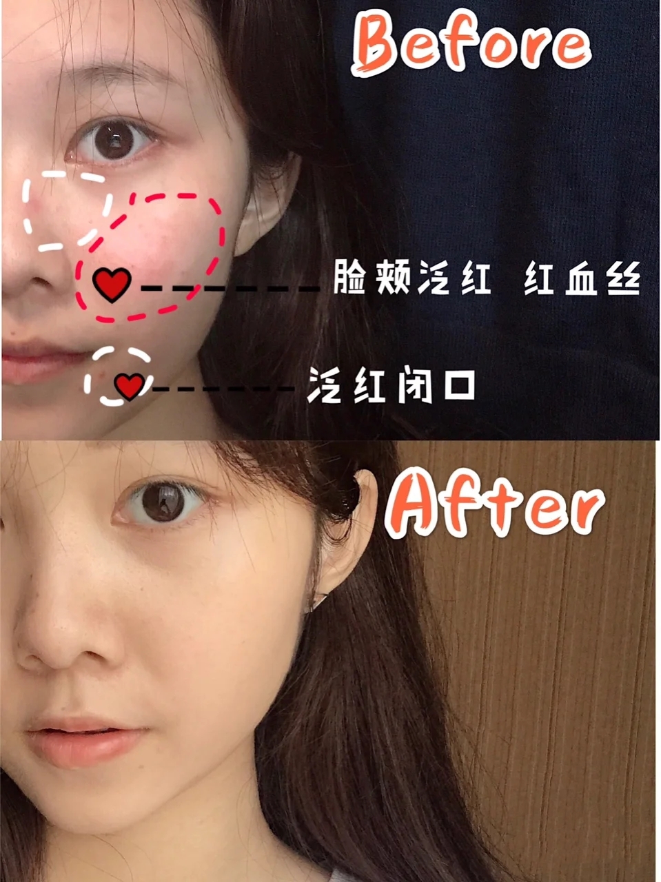 如何远离痘痘肌,远离痘痘的方法