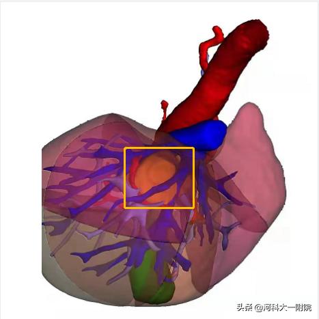 如何战胜肝癌,肝癌有没有彻底治好的