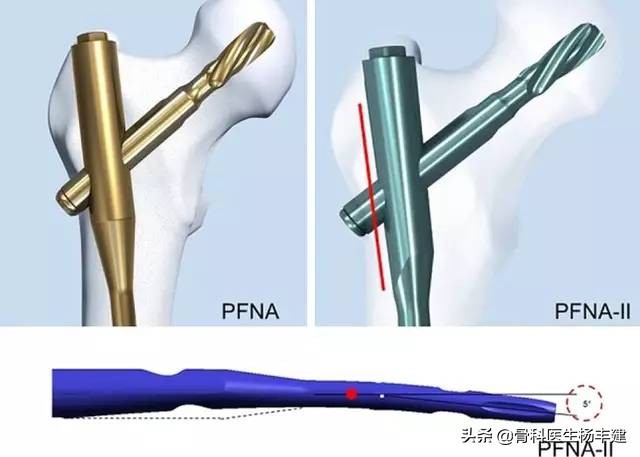 专家级科普，老年人的骨折与年轻人有哪些不一样？