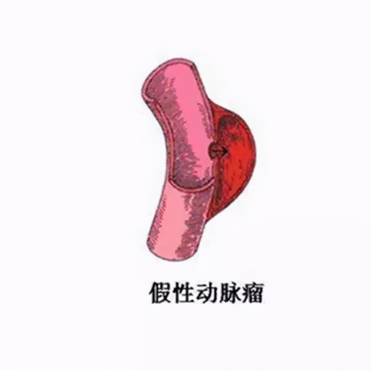 心脏康复的目的和意义,心脏康复的分期