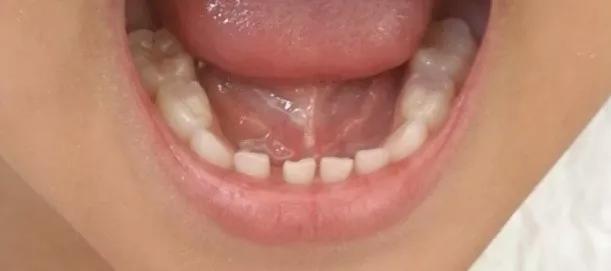 小孩用牙线对牙齿好吗,儿童牙线怎么护牙