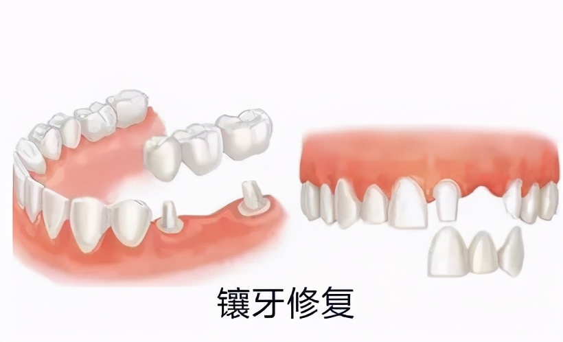 根管治疗做冠的牙齿会裂开吗,根管治疗后牙齿裂了还能做外冠吗