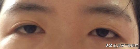 双眼皮长成内双了是怎么回事,双眼皮变成肉条的原因