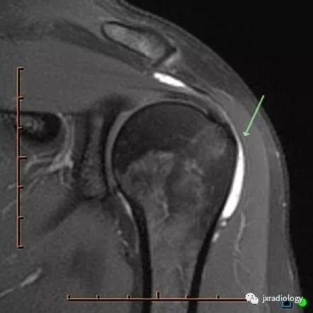 肩关节周围滑囊有哪些,肩关节滑囊疝严重吗