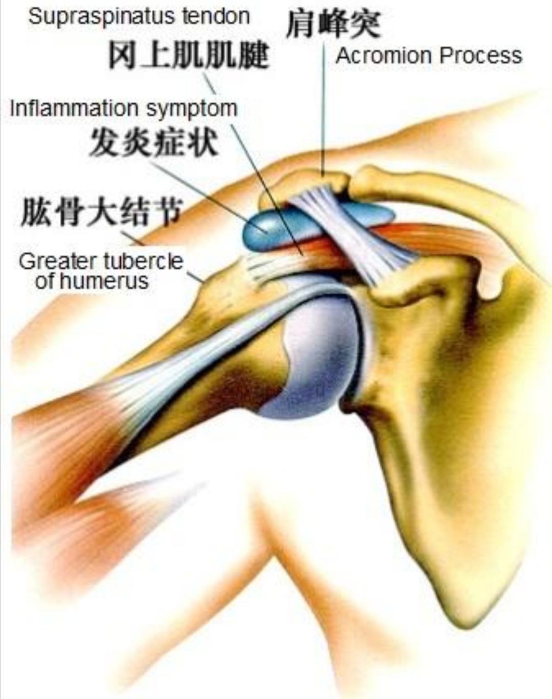 冈上肌损伤和肩周炎治疗方案,肩周炎冈上肌损伤怎么锻炼