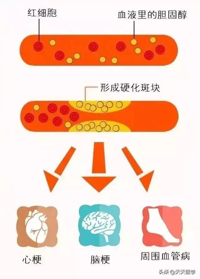 高脂血症饮食原则,高脂血症的饮食治疗方法有哪些