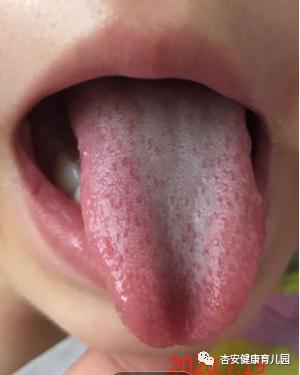 肺脾两虚咳嗽药膳食疗方,宝宝咳嗽的最佳食疗方法