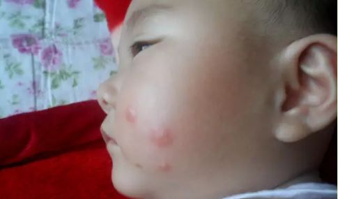 婴儿干性湿疹抹护肤品没有激素,宝宝湿疹要选抗过敏保湿护肤品