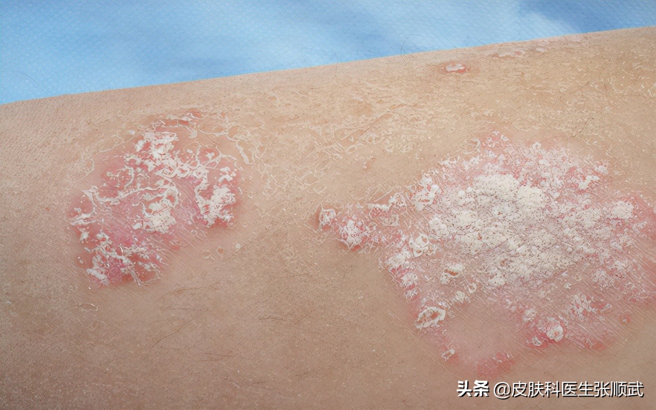 银屑病怎么治疗才好得快,看中医调理银屑病