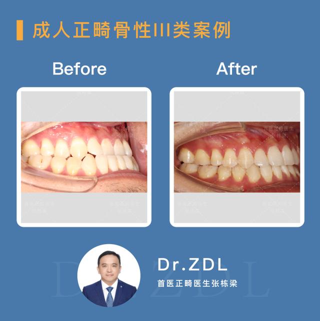 骨性龅牙做正畸还是正颌,骨性龅牙正颌手术前要正畸吗