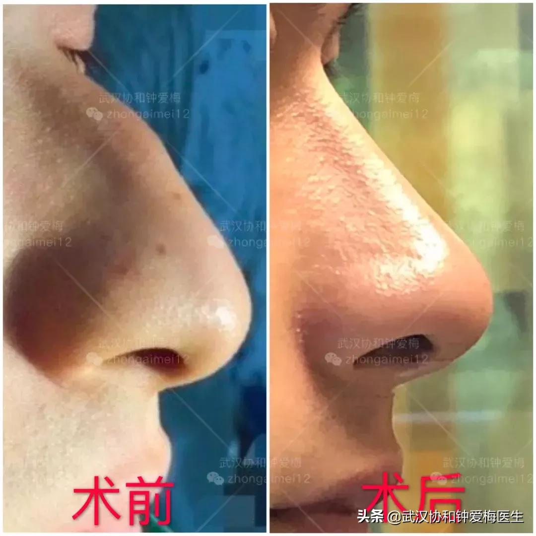 什么样的鼻子好看图片,男生什么样的鼻子最好看