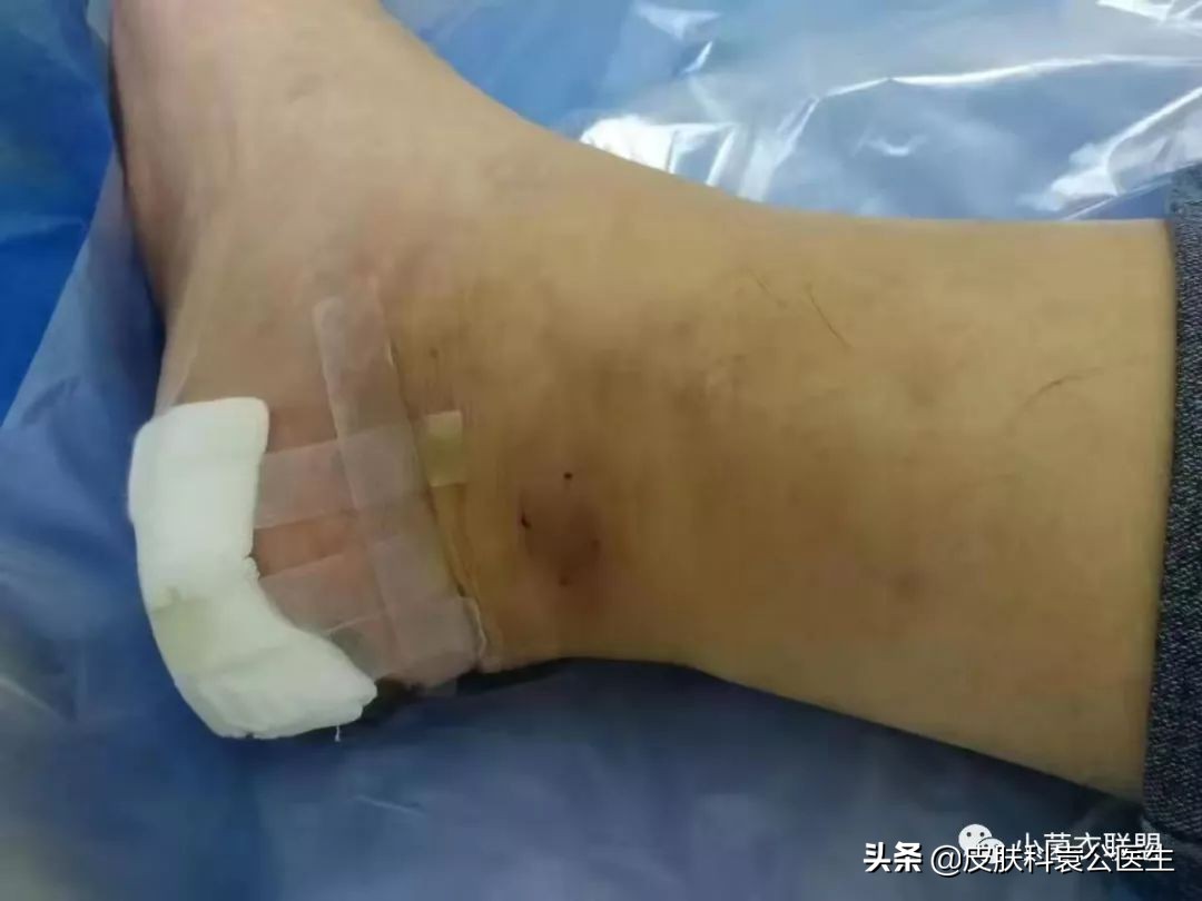 边缘不整齐的痣都是黑色素瘤吗,痣突然变大不规则一定是黑色素瘤