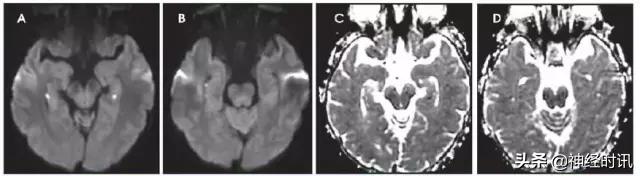 脑卒中的快速识别ppt,脑卒中神经影像学实例解析